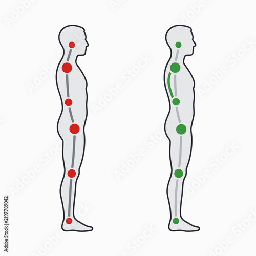 Human Spine Alignment Comparison Diagram Illustration