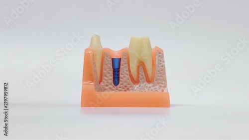Dental Implant Crown Placement on Jaw Model by Dentist Hand in Glove, Prosthetic Dentistry Procedure