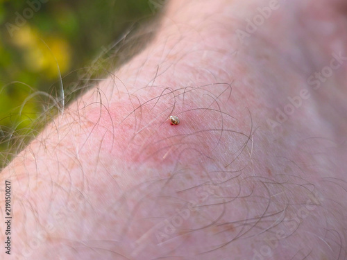 The bee left a sting with a vial of poison in the mans skin.