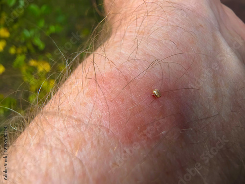 The bee left a sting with a vial of poison in the mans skin.