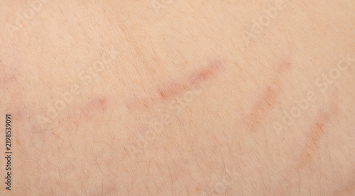 Fotografie Scars from stretch marks, striae on skin texture closeup