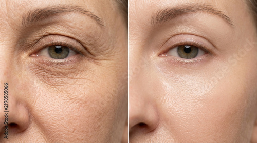 Before and After Wrinkle Reduction: Woman's Eyes Skin Treatment Comparison