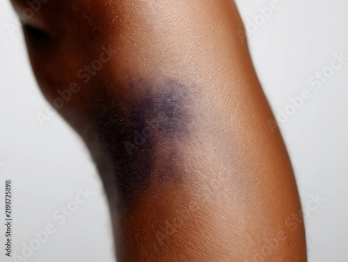 Close-Up Skin With Visible Dark Bruise