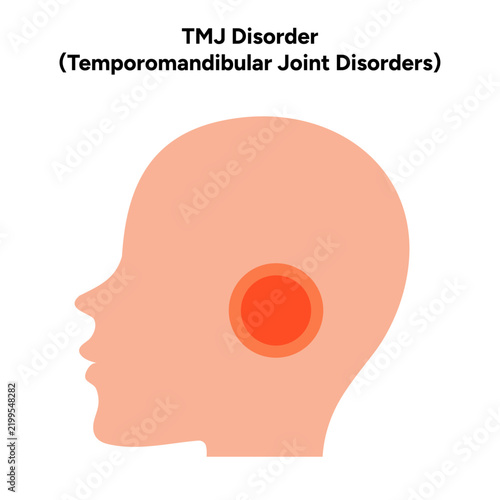 Detailed hand-drawn dental medical illustration depicting temporomandibular joint disorder (TMJ disorder). The artwork shows the anatomy of the temporomandibular joint