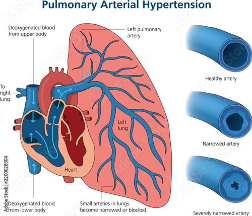 Pulmonary Arterial Hypertension Medical Illustration