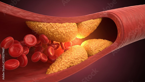 Cholesterol Plaque Build Up in Artery Blocking Red Blood Cells 3D Render