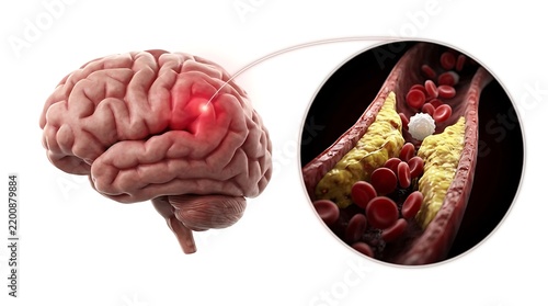 Brain stroke and blood vessel with cholesterol plaque