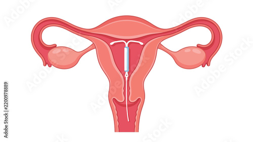 Anatomical uterus vector illustration showing intrauterine device placement inside female reproductive system with pink soft colors