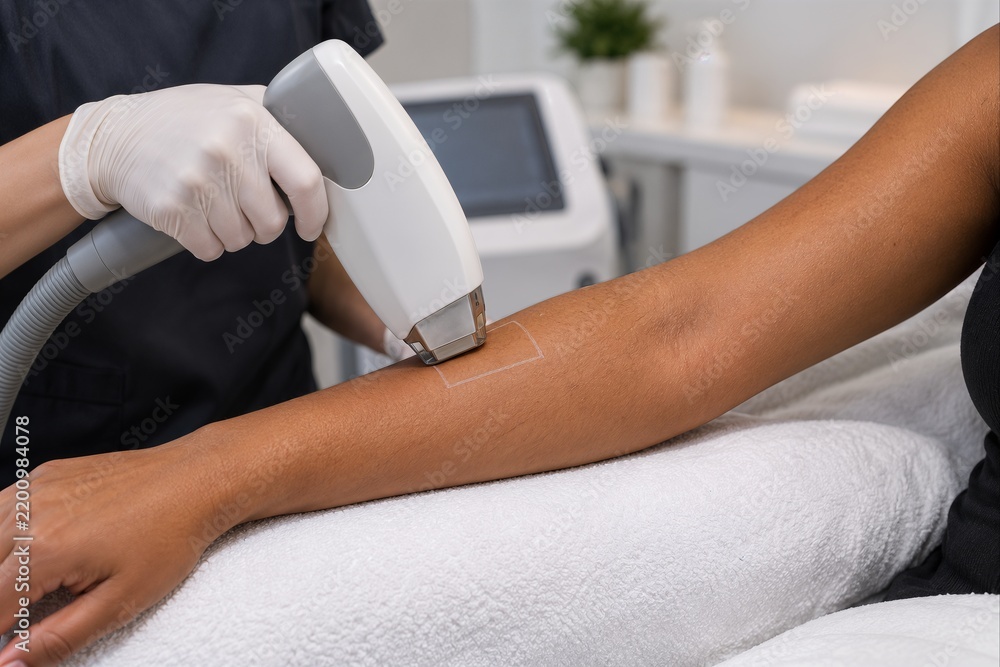 Fototapeta premium Laser Patch Test on Dark Skin Forearm Before Full Treatment
