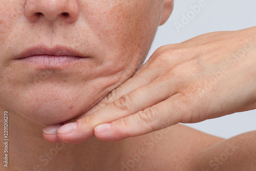 Woman s face showing jowls and nasolabial folds with a hand supporting the cheek