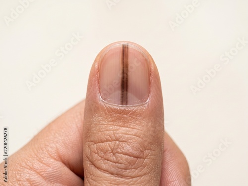 Dark longitudinal streak on fingernail with clean copy space