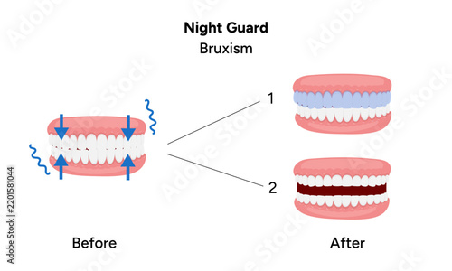 Detailed hand-drawn dental medical illustration depicting bruxism and its treatment with a night guard