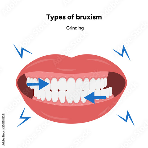 Detailed hand-drawn dental medical illustration depicting bruxism and its main types, including sleep bruxism and awake bruxism