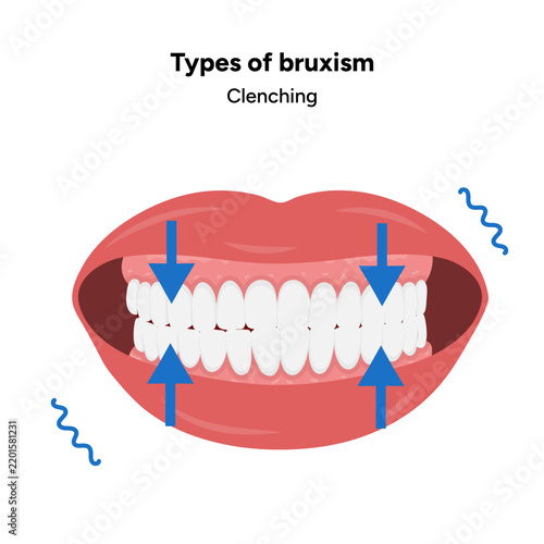 Detailed hand-drawn dental medical illustration depicting bruxism and its main types, including sleep bruxism and awake bruxism