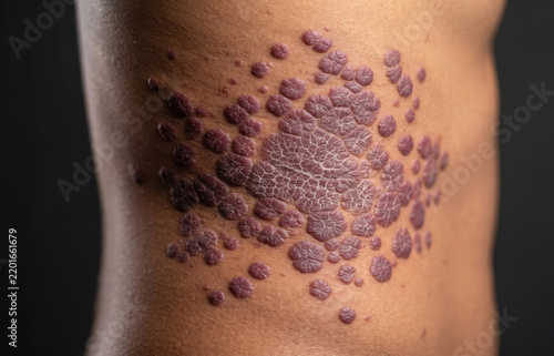 Multiple polygonal violaceous pruritic plaques of lichen planus on human trunk body skin surface