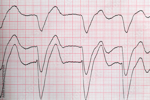 Electrocardiogram trace showing abnormal cardiac rhythm lead signal on paper