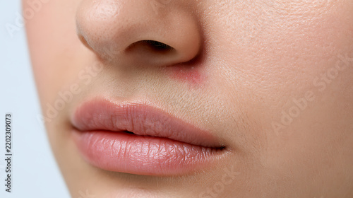 Close-up of a woman's face with a red pimple on her nose