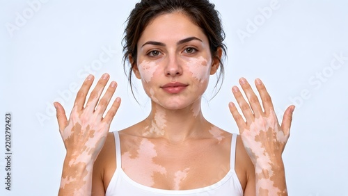 AI generated portrait of beautiful woman with vitiligo skin condition showing hands and face with confidence