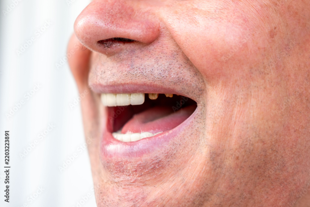 Fototapeta premium closeup senior man smiling showing dental bridge and natural teeth, partial denture visible, mixed teeth, oral health, dental prosthetics, emotional smile, stomatology, before and after open-mouthed