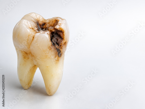 Molar with visible dental decay and caries