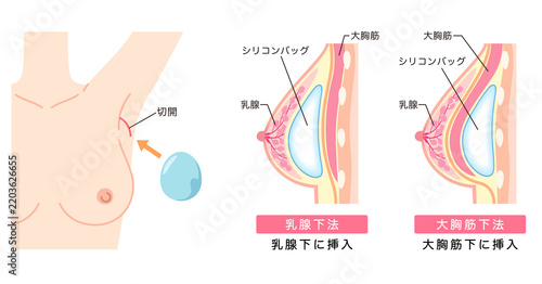 豊胸手術の構造　シリコンバッグを入れた胸