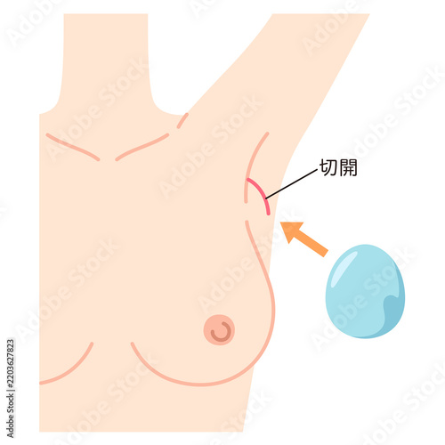 豊胸手術の構造　シリコンバッグを入れた胸