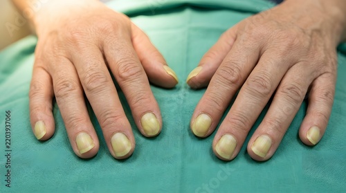 Close-up of Hands with Yellow Fingernails and Nail Fungus Infection Symptoms