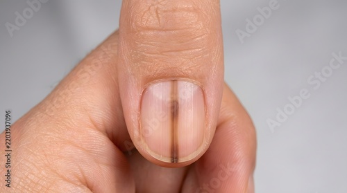 Macro Close-up of Longitudinal Melanonychia Vertical Dark Line on Fingernail Medical Dermatology Concept