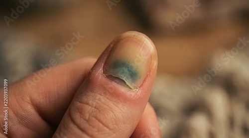 Macro Shot of a Damaged and Discolored Fingernail with Subungual Hematoma and Bruising