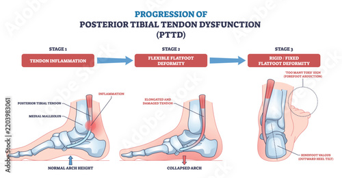 Posterior tibial tendon dysfunction progression shown across three stages, highlighting foot bones, tendon, and arch collapse with arrows and labels. Outline diagram