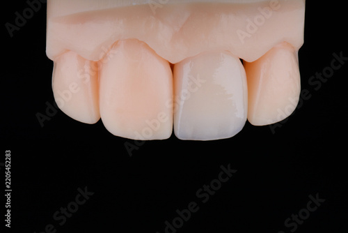 Mirror copy of central maxillary incisor, ultra thin dental ceramic veneer or crown on printed model