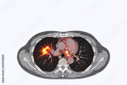 Fused PET CT Chest Scan Showing Tracer Activity