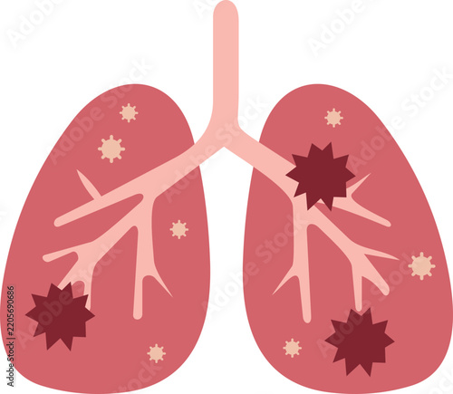 Pneumonia Illustration