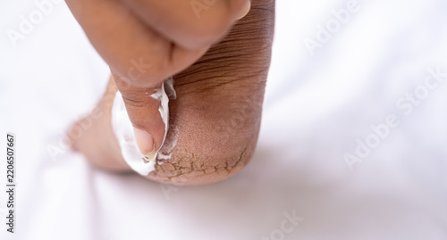 Bild auf Leinwand Close up of woman applying moisturizing cream to a dry cracked heel on a foot resting on a white towel showing skin care treatment and health wellness