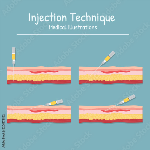 Injection Technique Medical Illustrations