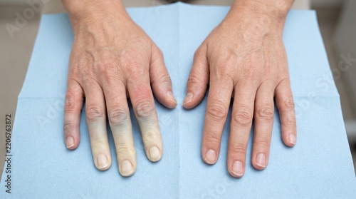 Raynaud Phenomenon with Finger Color Changes