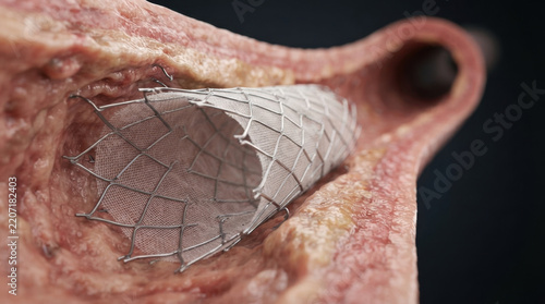 Aortic stent graft inside damaged vessel opening, showing expandable metal framework and fabric lining during medical implantation procedure