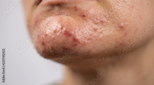 Acne blemishes on inflamed skin close-up view, depicting dermatological condition and skin health.