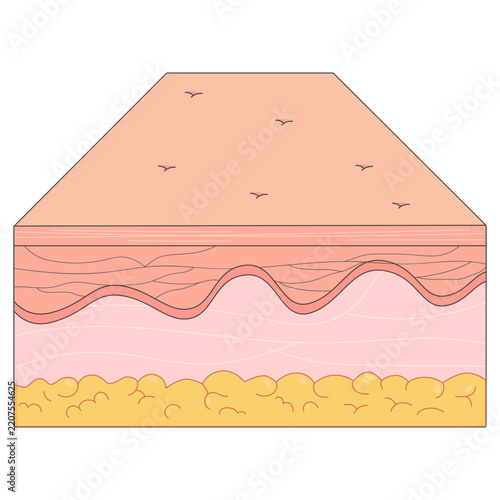 Burns Level 0  Medical Illustrations
