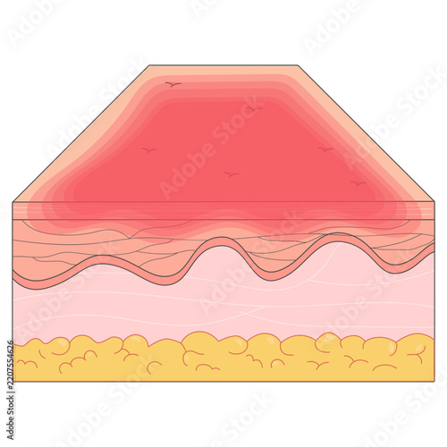 Burns  Level 1 Medical Illustrations