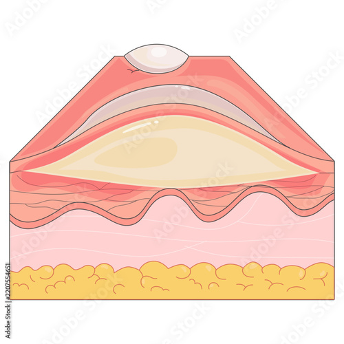 Burns Level 2 Medical Illustrations