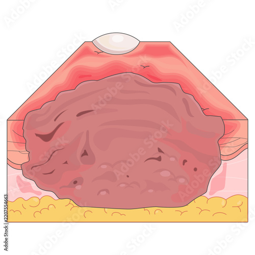 Burns Level 3Medical Illustrations