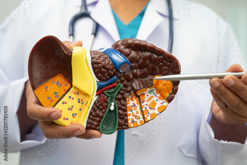 Cirrhosis, Liver cancer, fatty liver, Asian doctor with liver human model.
