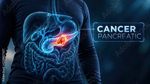 Pancreatic cancer awareness concept showing illuminated tumor within human digestive system for medical education and health communication purposes