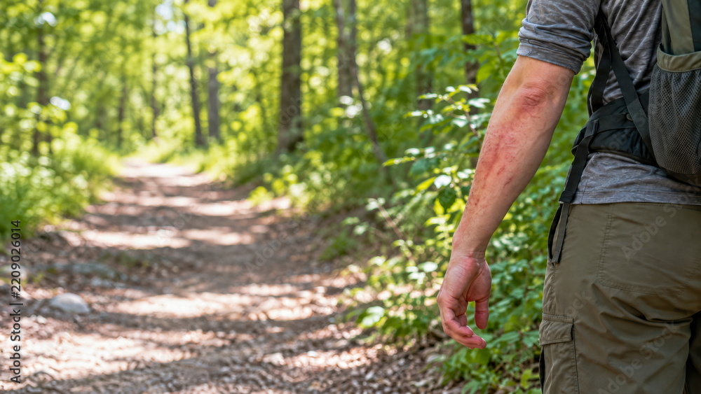 Fototapeta premium Hiker with visible forearm rash on a woodland trail and green copy space