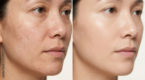Skin Transformation: Before and After - Clear, Smooth Complexion