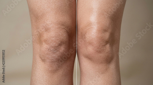 Close-up of Dry, Textured Human Knees with Visible Skin Imperfections