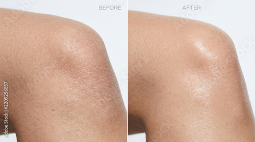 Skin Transformation: Before and After Dryness Treatment, Hydrated Smooth Knee