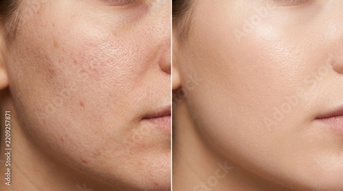 Skin transformation: Before and after foundation makeup application