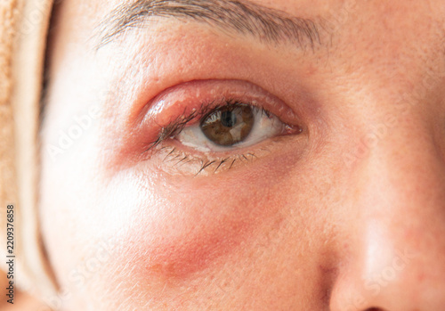 Close-Up of a Middle-Aged Woman with a Swollen Eyelid and Stye